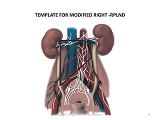 TEMPLATE FOR MODIFIED RIGHT -RPLND
16
Dept of Urology, GRH and KMC, Chennai.
 