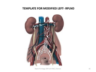 TEMPLATE FOR MODIFIED LEFT- RPLND
18
Dept of Urology, GRH and KMC, Chennai.
 