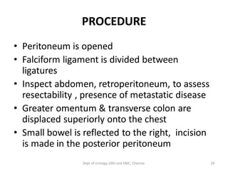 PROCEDURE
• Peritoneum is opened
• Falciform ligament is divided between
ligatures
• Inspect abdomen, retroperitoneum, to assess
resectability , presence of metastatic disease
• Greater omentum & transverse colon are
displaced superiorly onto the chest
• Small bowel is reflected to the right, incision
is made in the posterior peritoneum
28
Dept of Urology, GRH and KMC, Chennai.
 