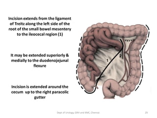 Incision extends from the ligament
of Treitz along the left side of the
root of the small bowel mesentery
to the ileocecal region (1)
It may be extended superiorly &
medially to the duodenojejunal
flexure
Incision is extended around the
cecum up to the right paracolic
gutter
29
Dept of Urology, GRH and KMC, Chennai.
 