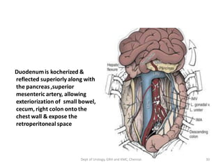 Duodenumis kocherized &
reflected superiorly along with
the pancreas,superior
mesenteric artery, allowing
exteriorization of small bowel,
cecum, right colon onto the
chest wall & expose the
retroperitoneal space
30
Dept of Urology, GRH and KMC, Chennai.
 