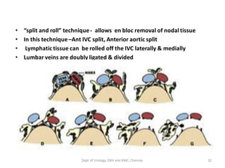• “split and roll” technique- allows en bloc removal of nodal tissue
• In this technique–Ant IVC split, Anterior aortic split
• Lymphatic tissue can be rolled off the IVC laterally & medially
• Lumbar veins are doubly ligated & divided
32
Dept of Urology, GRH and KMC, Chennai.
 