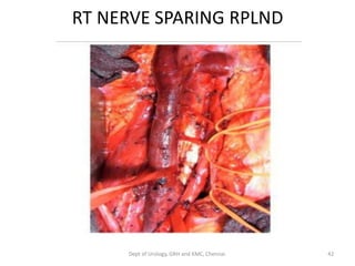 RT NERVE SPARING RPLND
42
Dept of Urology, GRH and KMC, Chennai.
 