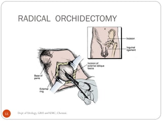 RADICAL ORCHIDECTOMY
11 Dept of Urology, GRH and KMC, Chennai.
 