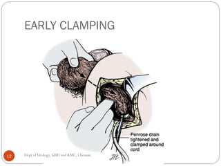 EARLY CLAMPING
12 Dept of Urology, GRH and KMC, Chennai.
 