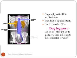  No prophylactic RT to
mediastinum
 Shielding of opposite testis
 Local control- 100%
Dog leg port –
top of T11 through L5 to
ipsilateral iliac nodes up to
mid-obturator foramen
22 Dept of Urology, GRH and KMC, Chennai.
 