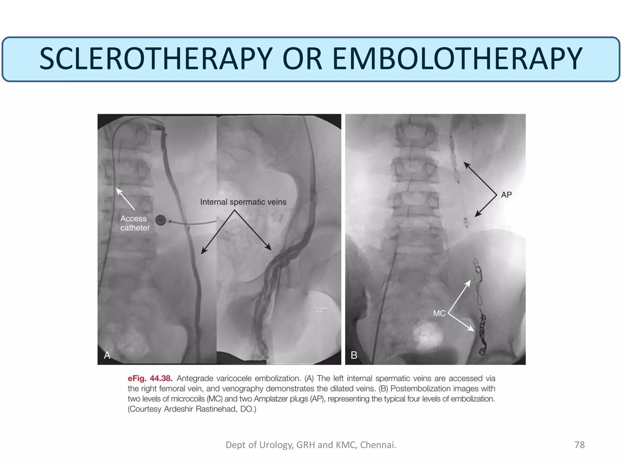 SCLEROTHERAPY OR EMBOLOTHERAPY
78
Dept of Urology, GRH and KMC, Chennai.
 
