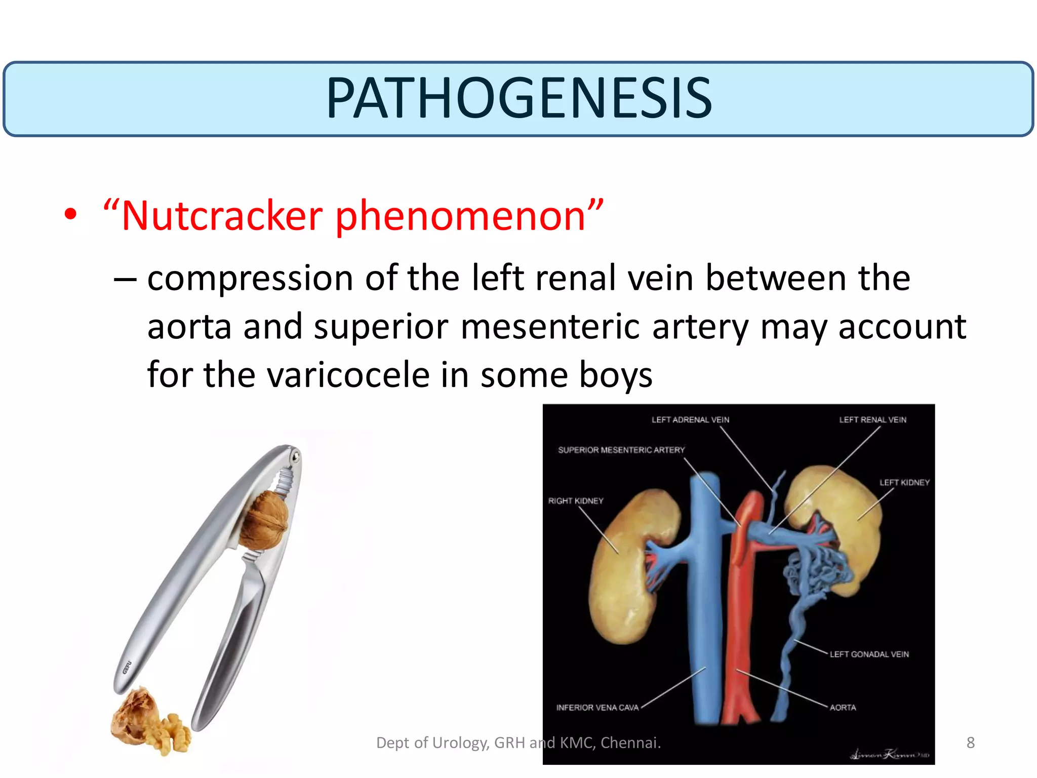 PATHOGENESIS
• “Nutcracker phenomenon”
– compression of the left renal vein between the
aorta and superior mesenteric artery may account
for the varicocele in some boys
8
Dept of Urology, GRH and KMC, Chennai.
 