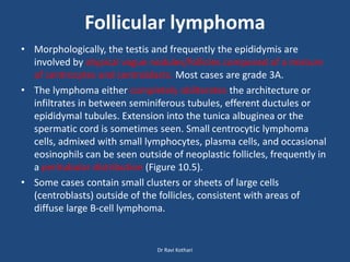 Follicular lymphoma
• Morphologically, the testis and frequently the epididymis are
involved by atypical vague nodules/follicles composed of a mixture
of centrocytes and centroblasts. Most cases are grade 3A.
• The lymphoma either completely obliterates the architecture or
infiltrates in between seminiferous tubules, efferent ductules or
epididymal tubules. Extension into the tunica albuginea or the
spermatic cord is sometimes seen. Small centrocytic lymphoma
cells, admixed with small lymphocytes, plasma cells, and occasional
eosinophils can be seen outside of neoplastic follicles, frequently in
a peritubular distribution (Figure 10.5).
• Some cases contain small clusters or sheets of large cells
(centroblasts) outside of the follicles, consistent with areas of
diffuse large B-cell lymphoma.
Dr Ravi Kothari
 