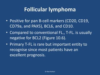 Follicular lymphoma
• Positive for pan B-cell markers (CD20, CD19,
CD79a, and PAX5), BCL6, and CD10.
• Compared to conventional FL., T-FL. is usually
negative for BCL2 (Figure 10.6).
• Primary T-FL is rare but important entity to
recognise since most patients have an
excellent prognosis.
Dr Ravi Kothari
 