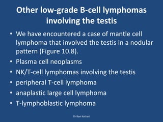 Other low-grade B-cell lymphomas
involving the testis
• We have encountered a case of mantle cell
lymphoma that involved the testis in a nodular
pattern (Figure 10.8).
• Plasma cell neoplasms
• NK/T-cell lymphomas involving the testis
• peripheral T-cell lymphoma
• anaplastic large cell lymphoma
• T-lymphoblastic lymphoma
Dr Ravi Kothari
 