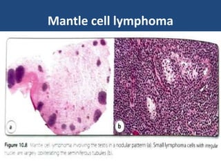 Mantle cell lymphoma
 