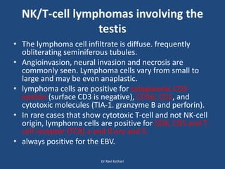NK/T-cell lymphomas involving the
testis
• The lymphoma cell infiltrate is diffuse. frequently
obliterating seminiferous tubules.
• Angioinvasion, neural invasion and necrosis are
commonly seen. Lymphoma cells vary from small to
large and may be even anaplastic.
• lymphoma cells are positive for cytoplasmic CD3-
epsilon (surface CD3 is negative), CD56, CD2, and
cytotoxic molecules (TIA-1. granzyme B and perforin).
• In rare cases that show cytotoxic T-cell and not NK-cell
origin, lymphoma cells are positive for CD8, CD5 and T-
cell receptor (TCR) a and ẞ ory and 5.
• always positive for the EBV.
Dr Ravi Kothari
 