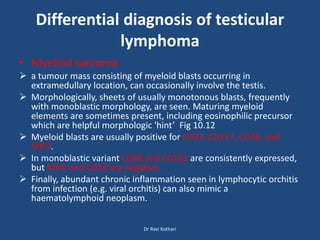 Differential diagnosis of testicular
lymphoma
• Myeloid sarcoma
 a tumour mass consisting of myeloid blasts occurring in
extramedullary location, can occasionally involve the testis.
 Morphologically, sheets of usually monotonous blasts, frequently
with monoblastic morphology, are seen. Maturing myeloid
elements are sometimes present, including eosinophilic precursor
which are helpful morphologic 'hint’ Fig 10.12
 Myeloid blasts are usually positive for CD33, CD117, CD34, and
MPO.
 In monoblastic variant CD68 and CD163 are consistently expressed,
but MPO and CD34 are negative.
 Finally, abundant chronic inflammation seen in lymphocytic orchitis
from infection (e.g. viral orchitis) can also mimic a
haematolymphoid neoplasm.
Dr Ravi Kothari
 