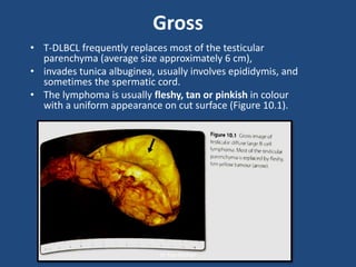 Gross
• T-DLBCL frequently replaces most of the testicular
parenchyma (average size approximately 6 cm),
• invades tunica albuginea, usually involves epididymis, and
sometimes the spermatic cord.
• The lymphoma is usually fleshy, tan or pinkish in colour
with a uniform appearance on cut surface (Figure 10.1).
Dr Ravi Kothari
 