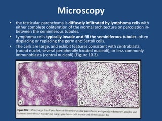 Microscopy
• the testicular parenchyma is diffusely infiltrated by lymphoma cells with
either complete obliteration of the normal architecture or percolation in-
between the seminiferous tubules.
• Lymphoma cells typically invade and fill the seminiferous tubules, often
displacing or replacing the germ and Sertoli cells.
• The cells are large, and exhibit features consistent with centroblasts
(round nuclei, several peripherally located nucleoli), or less commonly
immunoblasts (central nucleoli) (Figure 10.2).
 