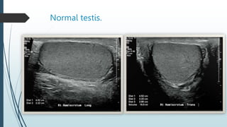 Normal testis.
 