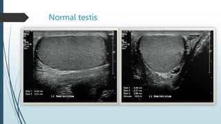 Normal testis
 