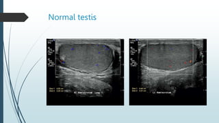 Normal testis
 