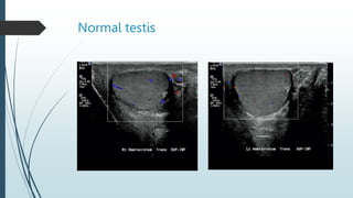 Normal testis
 