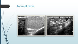 Normal testis
head
bod
y
tai
l
 