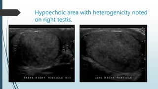 Hypoechoic area with heterogenicity noted
on right testis.
 