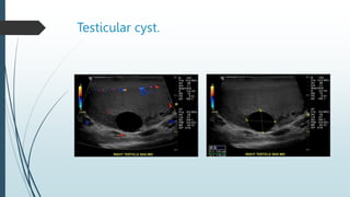 Testicular cyst.
 