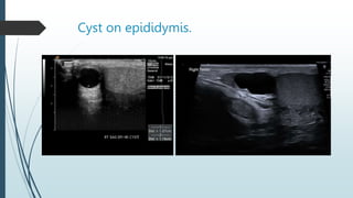 Cyst on epididymis.
 