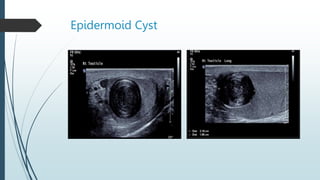 Epidermoid Cyst
 