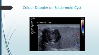 Colour Doppler on Epidermoid Cyst
 