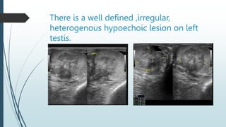There is a well defined ,irregular,
heterogenous hypoechoic lesion on left
testis.
 