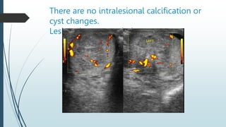 There are no intralesional calcification or
cyst changes.
Lesion shows vascularity.
 