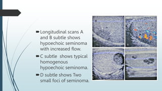 Longitudinal scans A
and B subtle shows
hypoechoic seminoma
with increased flow.
C subtle shows typical
homogenous
hypoechoic seminoma.
D subtle shows Two
small foci of seminoma.
A
D
 