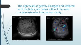 The right testis is grossly enlarged and replaced
with multiple cystic areas within it.the mass
contain extensive internal vascularity .
 