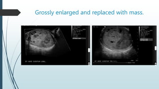 Grossly enlarged and replaced with mass.
 