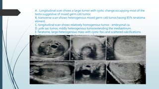 A , Longitudinal scan shows a large tumor with cystic change,occupying most of the
testis.suggestive of mixed germ cell tumor.
B, transverse scan shows heterogenous mixed germ cell tumor,having 85% teratoma
eliment.
C, longitudinal scan shows relatively homogenous tumor.- embryonal ca.
D ,yolk sac tumor, mildly heterogenous tumorextending the mediastinum.
E-Teratome, large heterogenous mass with cystic foci and scattered calcifications.
F- Choriocarcinoma ,relatively homogenous tumor.
A
D
 
