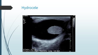 Hydrocele
 