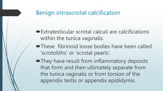 Benign intrascrotal calcification
Extratesticular scrotal calculi are calcifications
within the tunica vaginalis.
These fibrinoid loose bodies have been called
‘scrotoliths’ or ‘scrotal pearls’.
They have result from inflammatory deposits
that form and then ultimately separate from
the tunica vaginalis or from torsion of the
appendix testis or appendix epididymis.
 