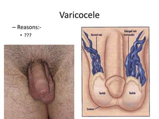 Varicocele
– Reasons:-
• ???
 