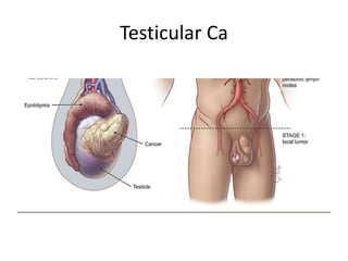 Testicular Ca
 