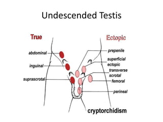 Undescended Testis
 
