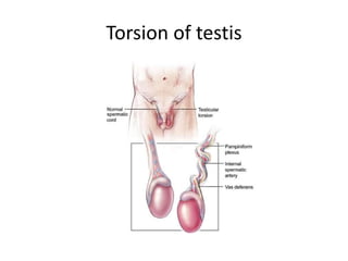 Torsion of testis
 