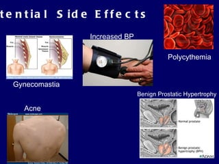 Potential  Side Effects Polycythemia Benign Prostatic Hypertrophy Acne Gynecomastia Increased BP 