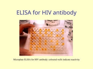 ELISA for HIV antibody
Microplate ELISA for HIV antibody: coloured wells indicate reactivity
 