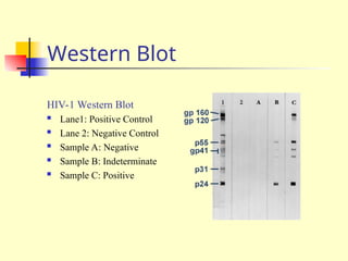 Western Blot
HIV-1 Western Blot
 Lane1: Positive Control
 Lane 2: Negative Control
 Sample A: Negative
 Sample B: Indeterminate
 Sample C: Positive
 