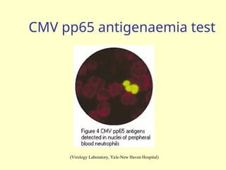 CMV pp65 antigenaemia test
(Virology Laboratory, Yale-New Haven Hospital)
 