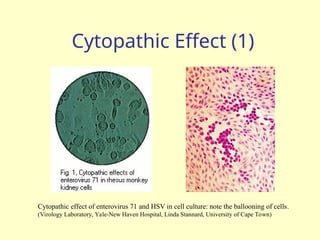 Cytopathic Effect (1)
Cytopathic effect of enterovirus 71 and HSV in cell culture: note the ballooning of cells.
(Virology Laboratory, Yale-New Haven Hospital, Linda Stannard, University of Cape Town)
 
