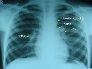 Appa Raddiology Tests associated with cardiac disorders | PPTX