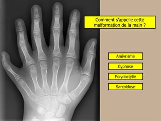 Comment s’appelle cette malformation de la main ? Anévrisme Cyphose Polydactylie Sarcoïdose 