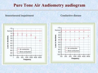 Tests of hearing | PPTX